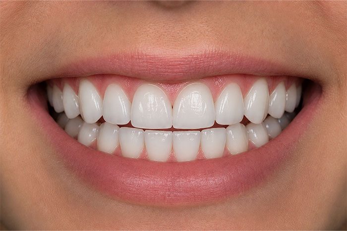 Cosmetic-Composite-Bonding-Path-after