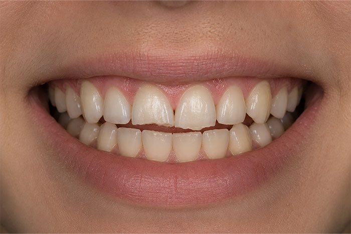 Cosmetic-Composite-Bonding-Path-before