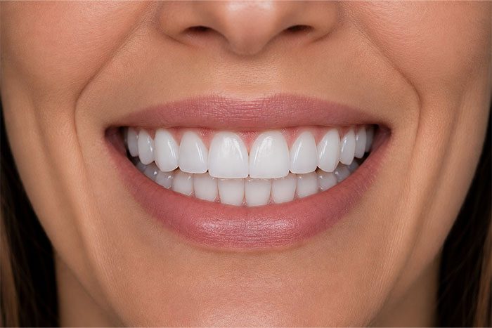 Porcelain-Veneers-Placement-Case-after