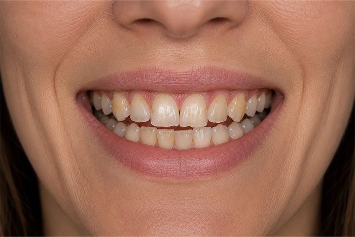 Porcelain-Veneers-Placement-Case-before