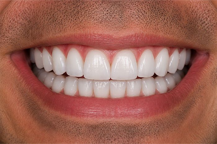 Smile-Makeover-after