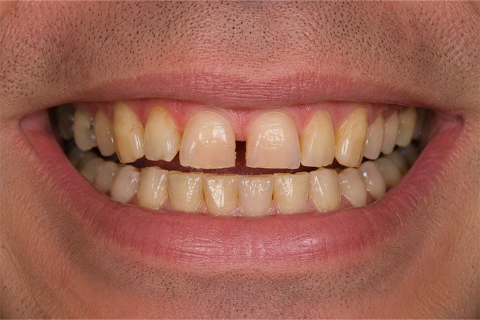 Smile-Makeover-before