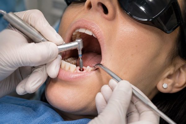 Dental-implants