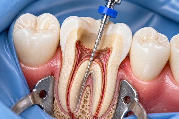Endodontics-(root-canal-therapy)