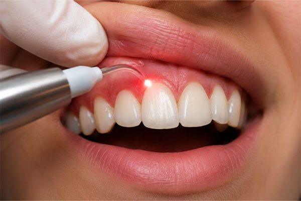 Laser-gum-treatment