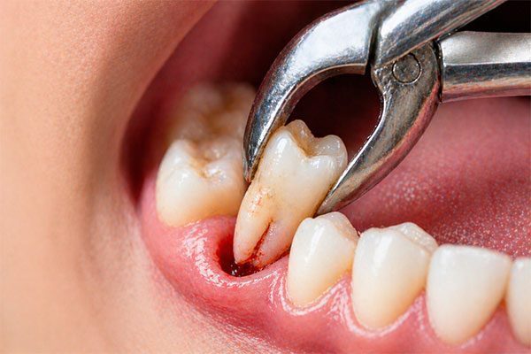Oral-surgery-and-extractions