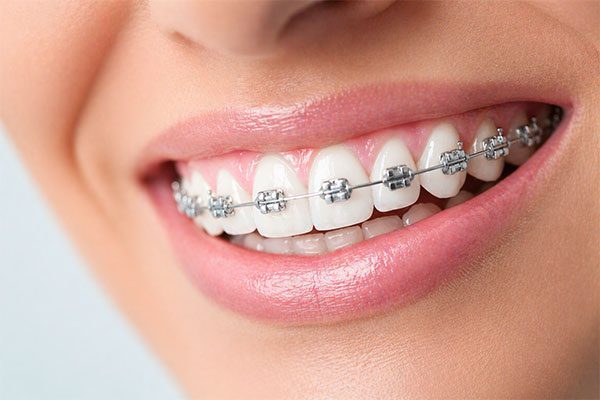 Orthodontics-and-alignment