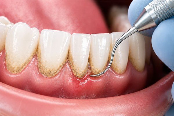 Periodontal-care
