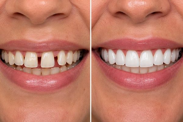 Smile-makeover