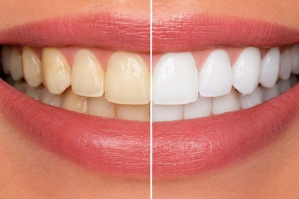 Teeth-Whitening