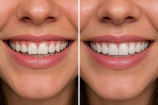 Tooth-contouring